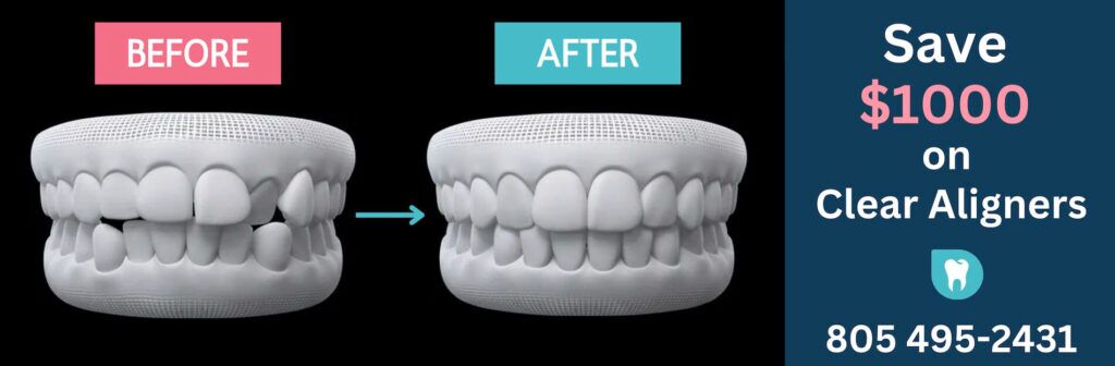 健康・医学 Aligner generation Clear aligner generations and orthodontic tooth movement