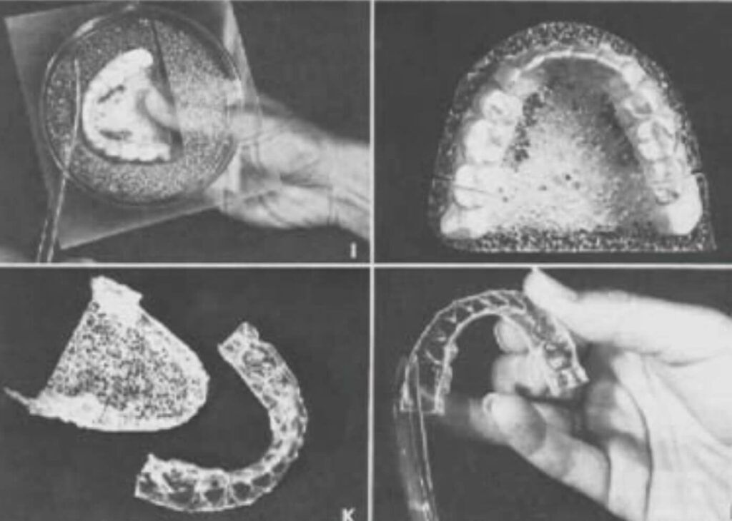 健康・医学 Aligner generation Full article: Clear aligners generations and orthodontic